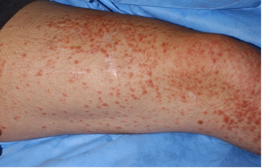 Cutaneous Leiomyoma Examples