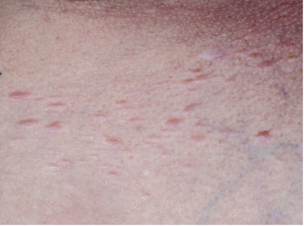 Cutaneous Leiomyoma Examples